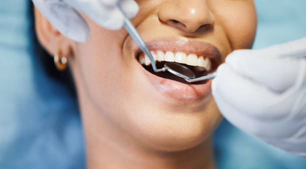 Best Chipped Tooth Repair Near Me  in Spencer, WV